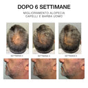 Confronto crescita capelli e barba uomo, miglioramento alopecia dopo 6 settimane, progressi visibili lato e sopra testa.